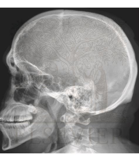 Skull: Lateral Radiograph