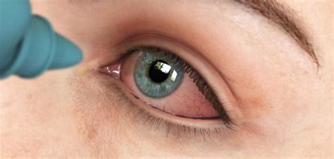 7 Reasons For Eye Infections | Marham