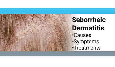 How To Treat Seborrheic Dermatitis | Dandruff Deconstructed