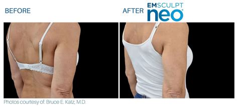 Emsculpt NEO Before and After | Real Patient Results