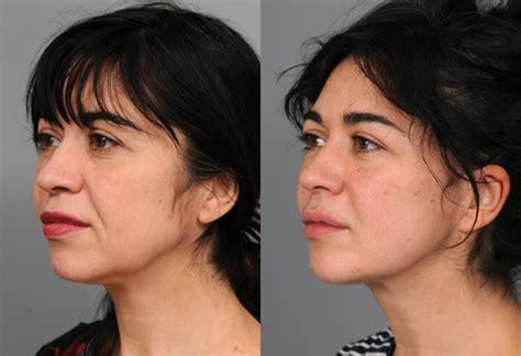 Naturalift™ Mini Facelift Before and After Photo Gallery | New York, NY | Thomas P. Sterry, MD