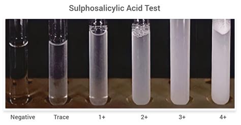 Sulphosalicylic Acid Test for Proteinuria: Principle and Procedure