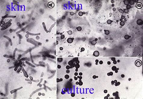 Tinea versicolor caused by Malassezia furfur infection and laboratory diagnosis | Medical ...