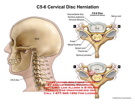 AMICUS Illustration of amicus,anatomy,cervical,intervertebral,disc ...