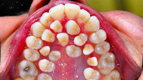 All My Teeth! Hyperdontia - Secrets to White Teeth! 😃😄😄😬 - YouTube