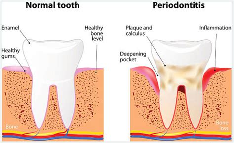 Deep Cleaning Bethel Park | Periodontal Therapy Mt. Lebanon | South Vue Dentistry