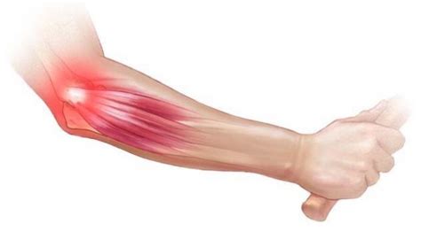 Tennis Elbow | DC Injury Clinic