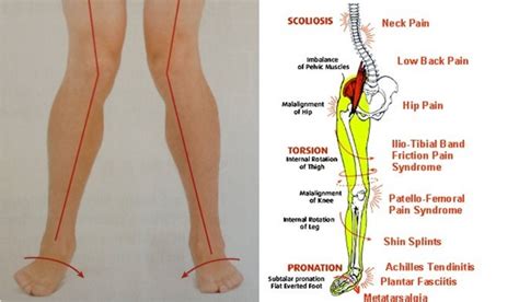 엎침 뒤틀림 증후군(Pronation distortion syndrome) : 네이버 블로그