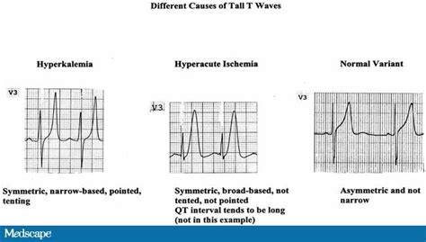 Series of Tall T Waves (I)