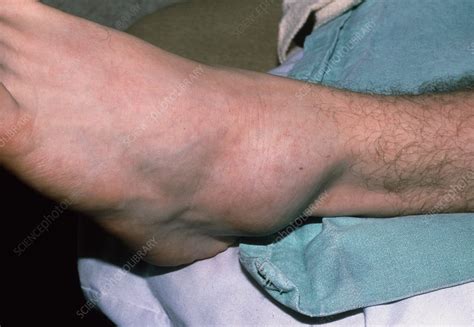 Swollen left ankle due to sprain - Stock Image - M330/0737 - Science ...