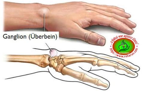 Bible Cyst; Causes, Symptoms, Diagnosis, Treatment - Rxharun