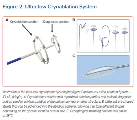 Ultra-low Cryoablation System | Radcliffe Cardiology