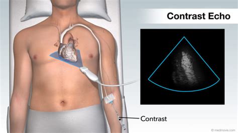 Types of Heart Ultrasound | See My Heart American Society of ...