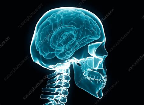 X-ray of the human brain and skull - Stock Image - F017/5967 - Science Photo Library