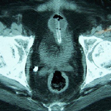 (PDF) Unusual Complication of Suprapubic Cystostomy in a Male Patient with Tetraplegia: Traction ...