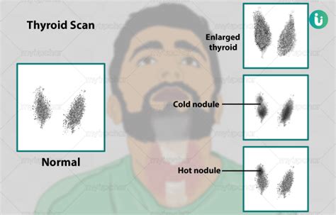 Thyroid Scan: Procedure, Purpose, Results, Cost, Price, Online booking