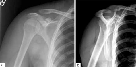 Anteroposterior radiograph (a) of the right shoulder de | Open-i