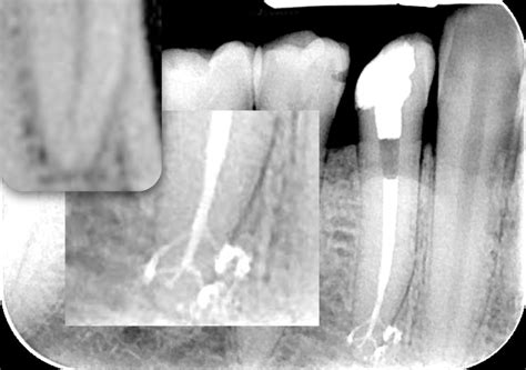 Endodontic Obturation Techniques: The State of the Art in 2015 | Dentistry Today CE