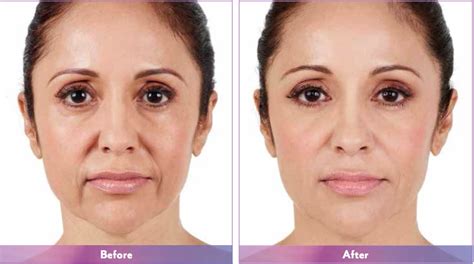 Dermal Fillers Colorado Springs, CO - PureLee Redefined - Juvéderm