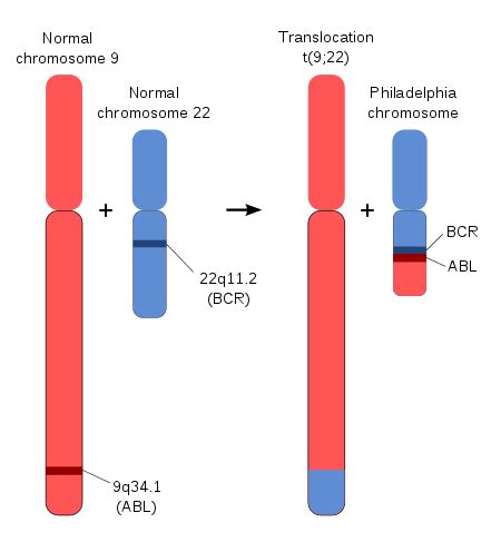 Philadelphia chromosome - Wikipedia