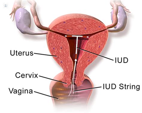 Intrauterine device (iud): what is it, symptoms and treatment | Top Doctors