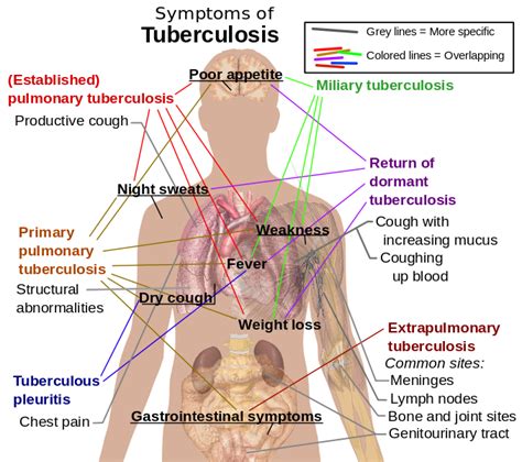 Tuberculosis symptoms – Health Tips Ever Magazine