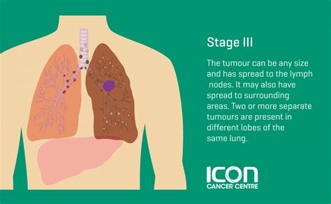 lung cancer early stage pneumonia symptoms Lung screening katy offered cancer tool reads connor ...