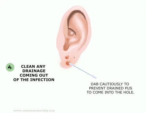 Ear Infection Ear Hole at David Roberts blog