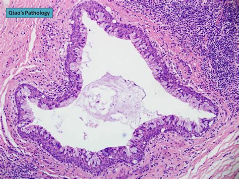 Preauricular First Branchial Cleft Cyst | Flickr