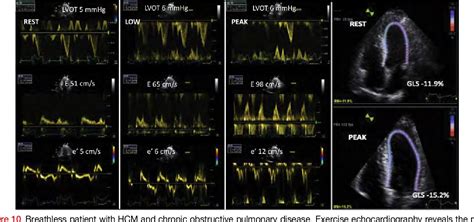 Table 1 from The clinical use of stress echocardiography in non ...