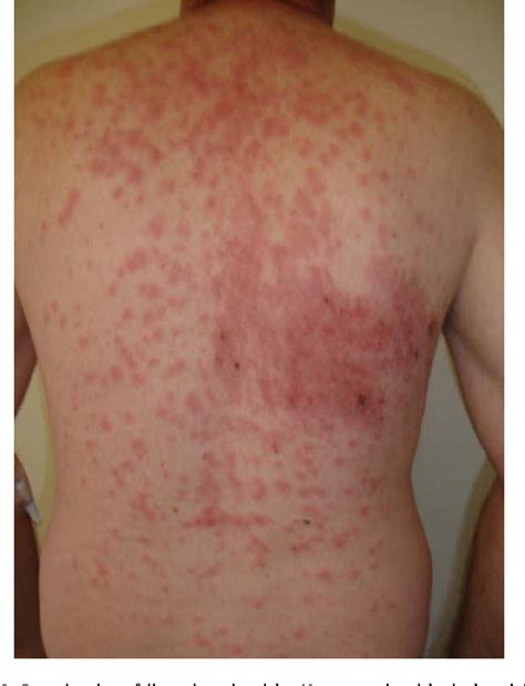 Figure 1 from A rare case of disseminated shingles in an immunocompetent patient following a 7 ...