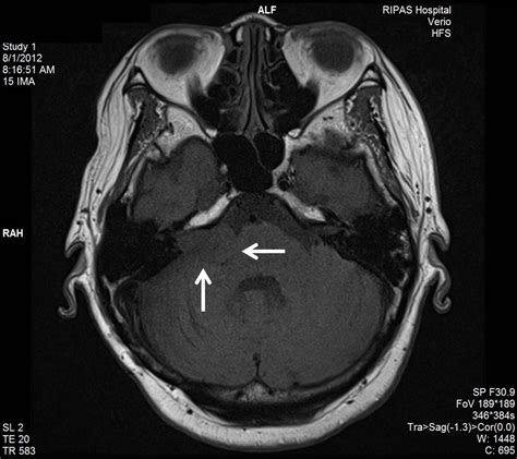 24+ Schwannoma Tumor Mri Pictures - Wallpaper Trends