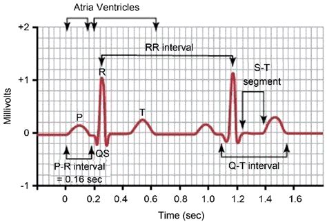 Traçage d'un signal ECG