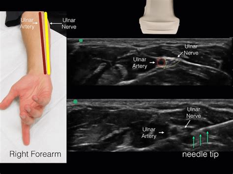 Trick of the Trade: Patient positioning for ultrasound-guided ulnar nerve block