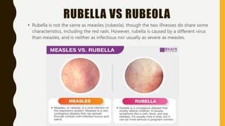 Rubella | PPT