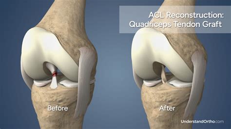 Torn ACL Reconstruction (Quadriceps Graft) – UnderstandOrtho™