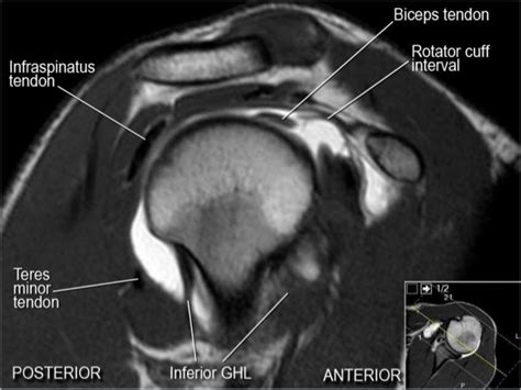 MRI Musculo-Skeletal Section: MRI anatomy of the shoulder (sagittal view).