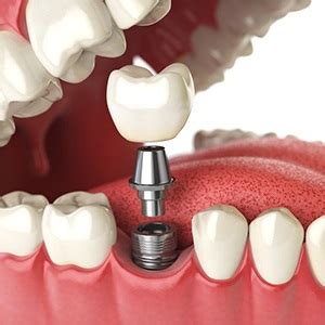 Immediate Loading Implants - Tooth Affair