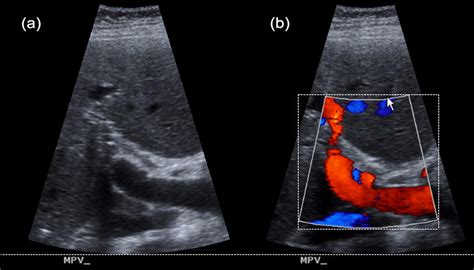 Portal Vein Thrombosis - The American Journal of Medicine