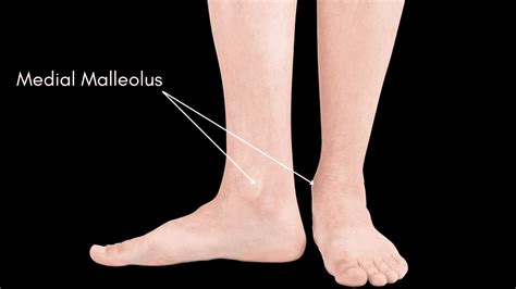 Medial Malleolus Pain: Get the answers from a Foot Specialist