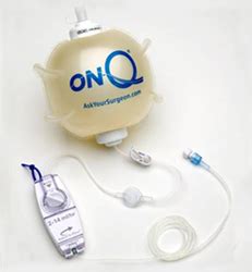 On-Q Pump - Gregory Nicholson MD | Gregory Nicholson MD