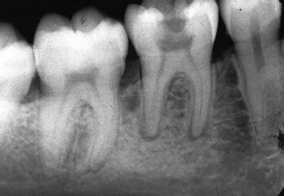 chronic apical periodontitis periapical radiograph – Dr. G's Toothpix