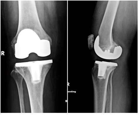 IMPLANT ATLAS — Hip & Knee Book