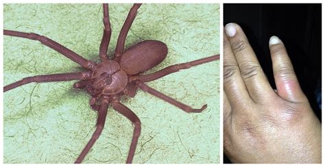 What You Need To Know About Brown Recluse Spider Bites