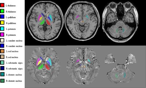 Substantia Nigra Red Nucleus