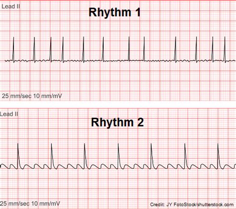 Atrial Flutter (A-Flutter) Quiz Questions ECG/EKG