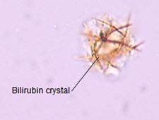 Bilirubin in Urine - Causes, Symptoms, Treatment