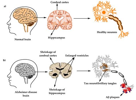 Molecules | Free Full-Text | Comprehensive Review on Alzheimer’s ...