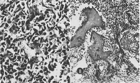 Figure 3 from Primary osteogenic sarcoma of the skull. | Semantic Scholar