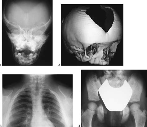 124 Cleidocranial Dysplasia | Radiology Key